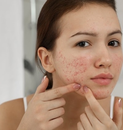 Menina adolescente espreme cravos e espinhas em casa